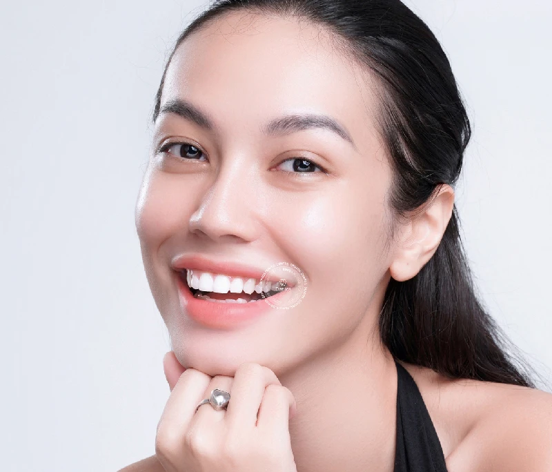 Cấu tạo răng Implant gồm những gì? Bí quyết chọn răng Implant phù hợp